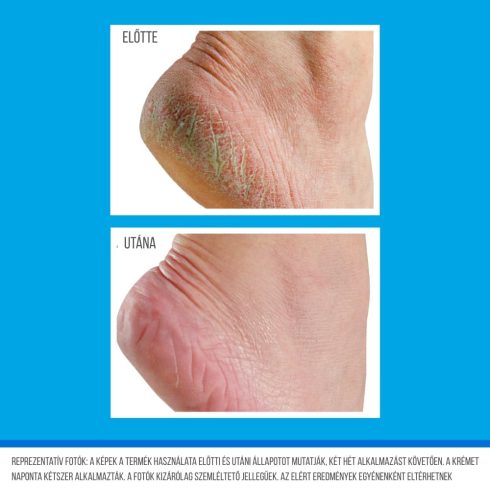 O’Keeffe’s Healthy Feet lábkrém használata előtt és után – repedezett, száraz sarok regenerálódásának bemutatása